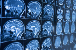 How Norden Leacox Accident & Injury Law Can Help With a Brain Injury Claim in Titusville, FL